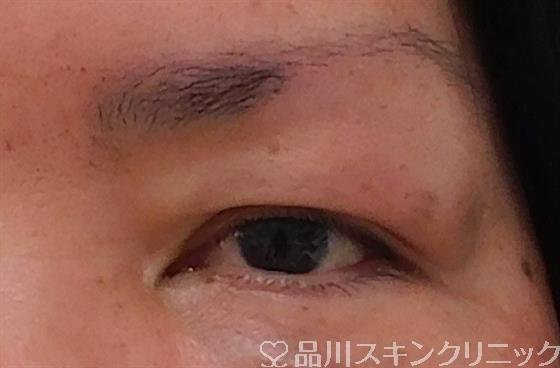 症例NO.41081のBEFORE写真