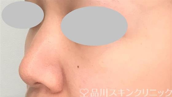 症例NO.58560のBEFORE写真