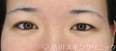 症例NO.66796のBEFORE写真