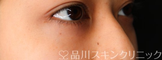 症例NO.69018のBEFORE写真