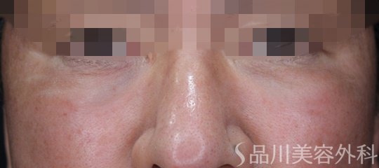 症例NO.67325のBEFORE写真