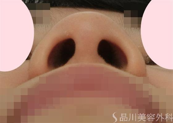 症例NO.28652のBEFORE写真