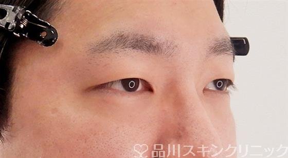 症例NO.58020のBEFORE写真