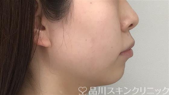 症例NO.57274のBEFORE写真