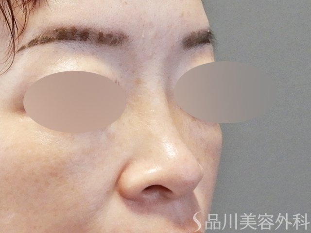 症例NO.66774のBEFORE写真