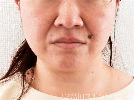 症例NO.56508のBEFORE写真