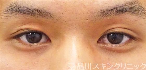 症例NO.49478のBEFORE写真