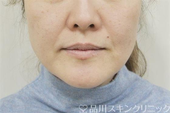 症例NO.39860のBEFORE写真