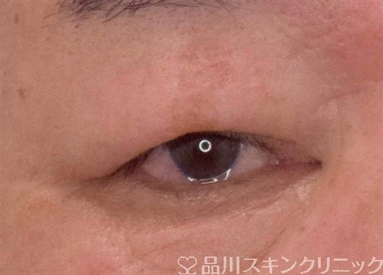 症例NO.61527のBEFORE写真