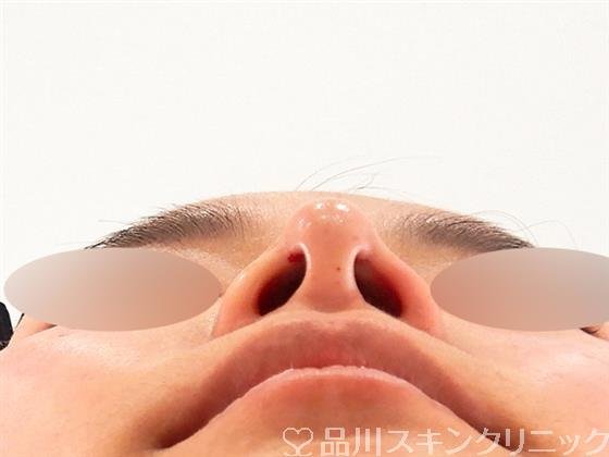 症例NO.59305のAFTER写真