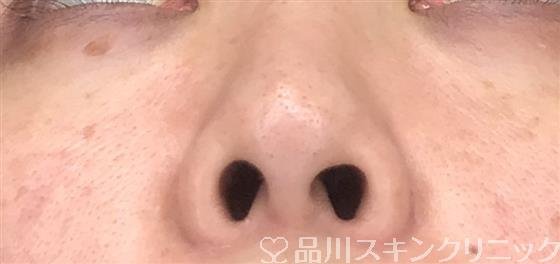 症例NO.53819のBEFORE写真