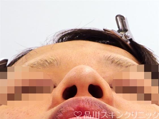 症例NO.48323のBEFORE写真