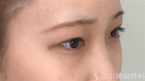 症例NO.56732のBEFORE写真