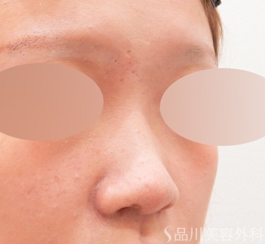 症例NO.62646のBEFORE写真