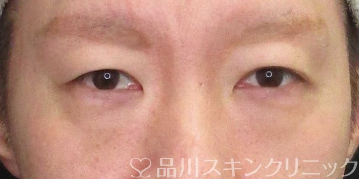 症例NO.67171のBEFORE写真