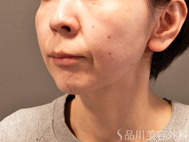 症例NO.68182のBEFORE写真