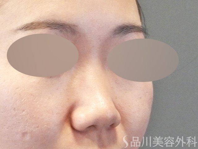 症例NO.64721のBEFORE写真