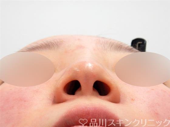 症例NO.53667のBEFORE写真