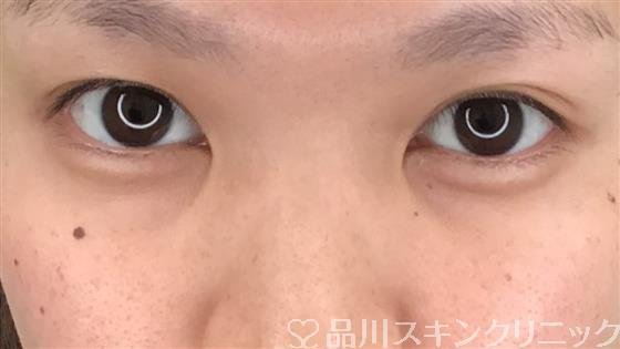 症例NO.55440のBEFORE写真