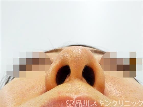 症例NO.48793のBEFORE写真