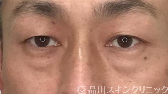 症例NO.57336のBEFORE写真