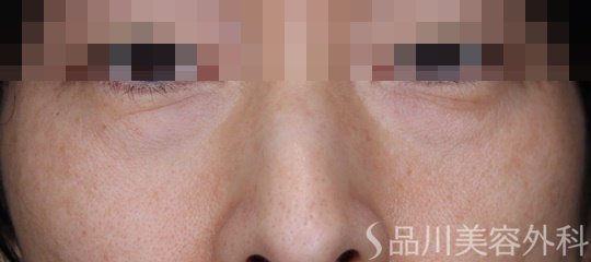 症例NO.67690のBEFORE写真