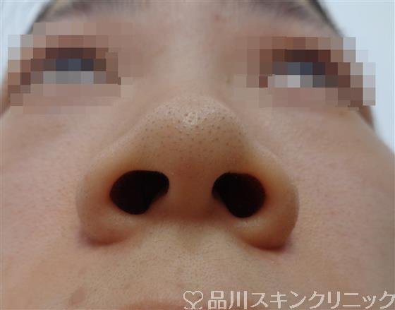 症例NO.48981のBEFORE写真