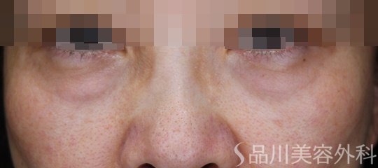 症例NO.68902のBEFORE写真