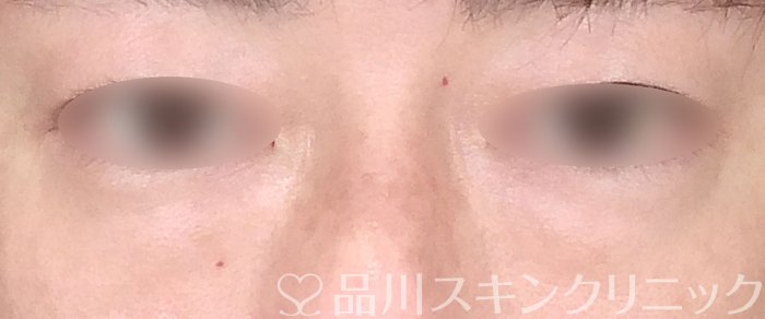 症例NO.65860のBEFORE写真