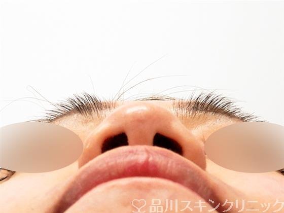 症例NO.54600のBEFORE写真