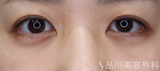 症例NO.68597のBEFORE写真