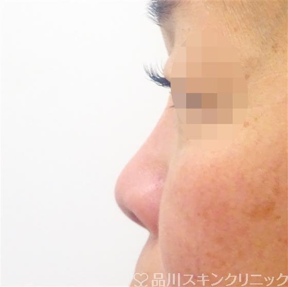 症例NO.45394のBEFORE写真