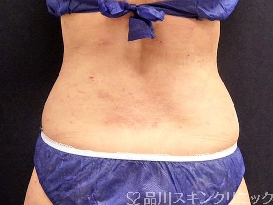 症例NO.51186のBEFORE写真