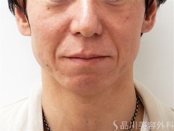 症例NO.55182のBEFORE写真