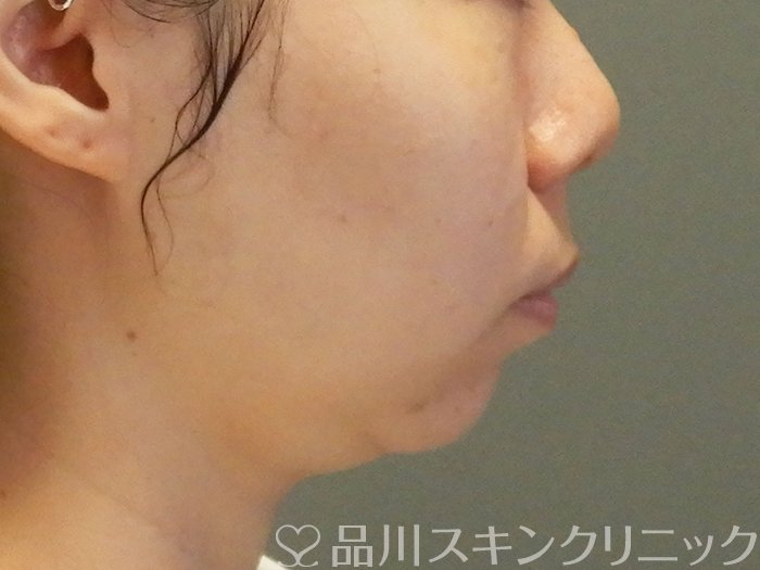 症例NO.67789のBEFORE写真