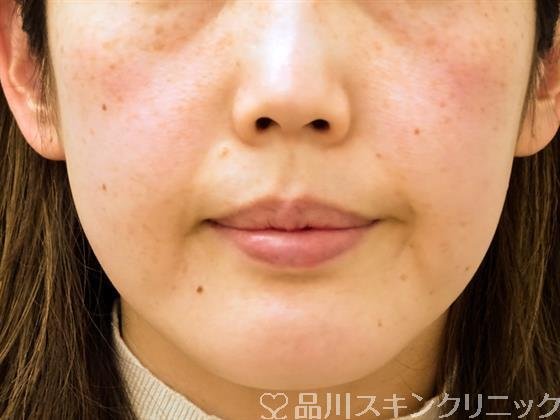 症例NO.52194のBEFORE写真