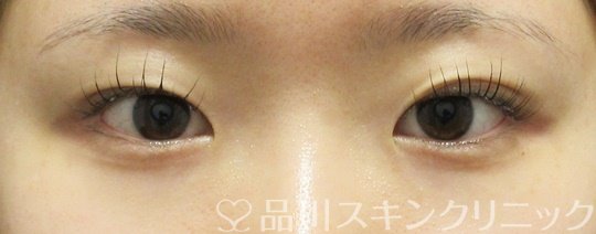 症例NO.68403のBEFORE写真