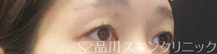 症例NO.62015のBEFORE写真