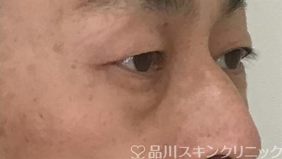 症例NO.57336のBEFORE写真