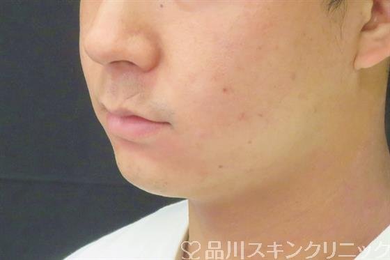 症例NO.61620のBEFORE写真