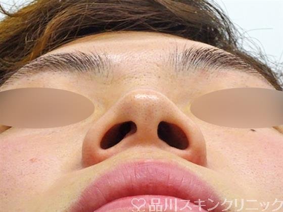 症例NO.50206のBEFORE写真