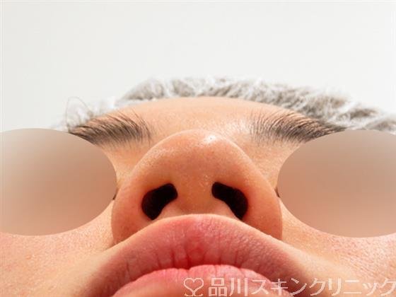 症例NO.53646のBEFORE写真