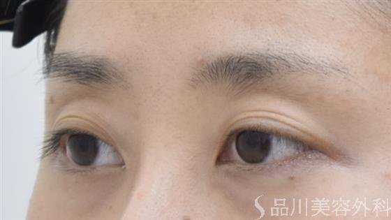 症例NO.43082のBEFORE写真