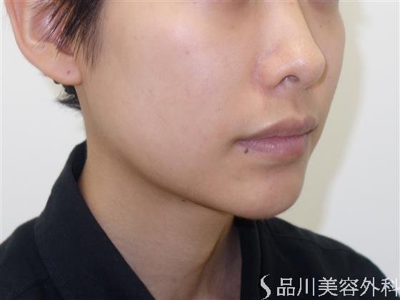 症例NO.42876のBEFORE写真