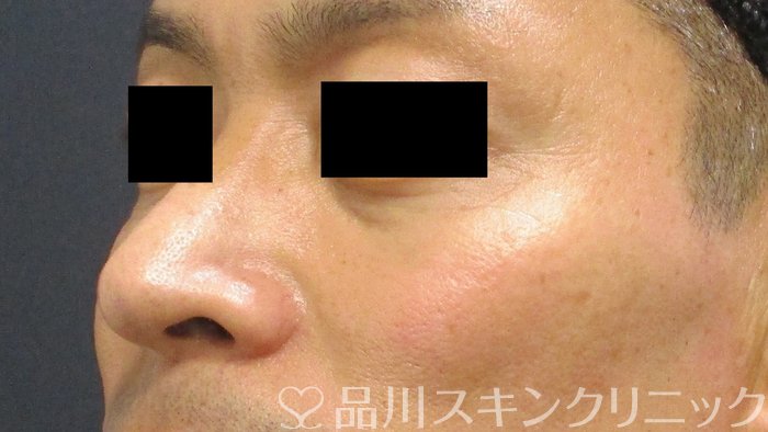 症例NO.64881のBEFORE写真