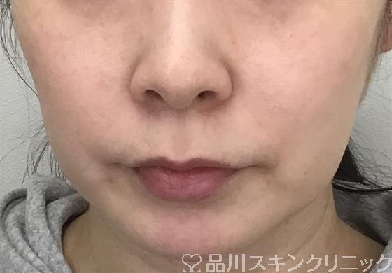 症例NO.54179のBEFORE写真