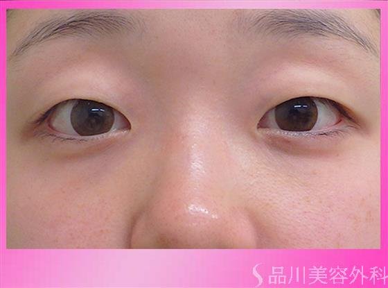 症例NO.48144のBEFORE写真