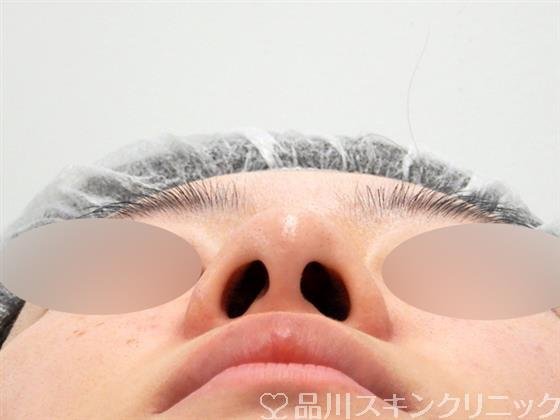 症例NO.53610のBEFORE写真