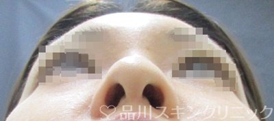 症例NO.67316のBEFORE写真