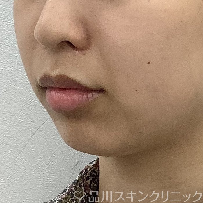 症例NO.66173のBEFORE写真